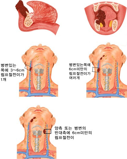 구강암 4기(A)