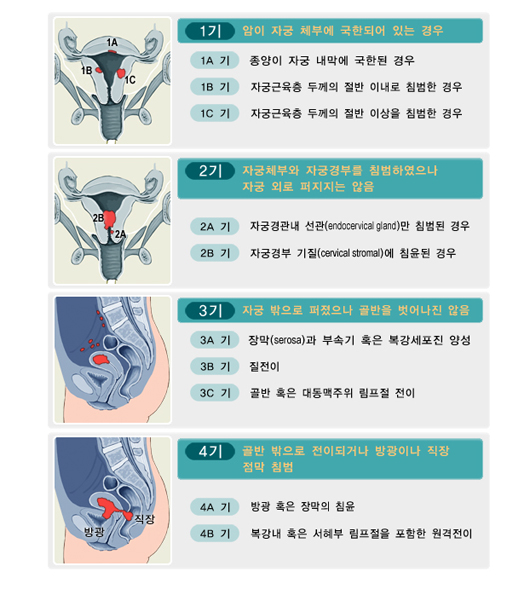 자궁내막암의 병기.  FIGO분류, 1988