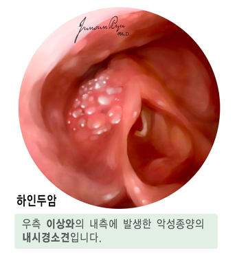 하인두암