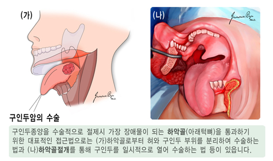 구인두암의 수술