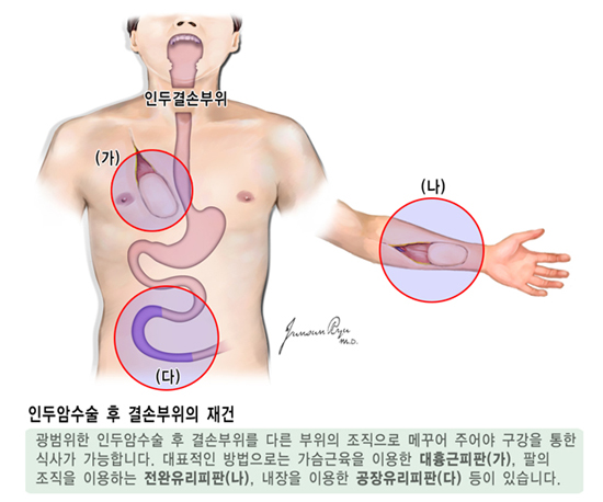 인두암수술 후 결손부위의 재건