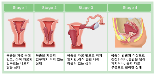 자궁육종의 진행단계