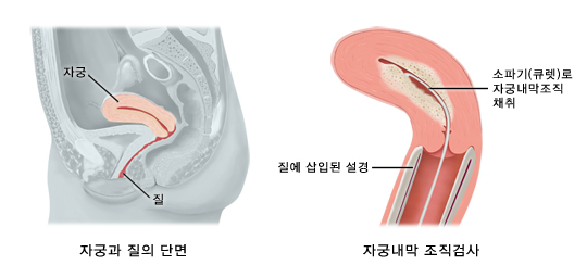 자궁육종의 조직검사