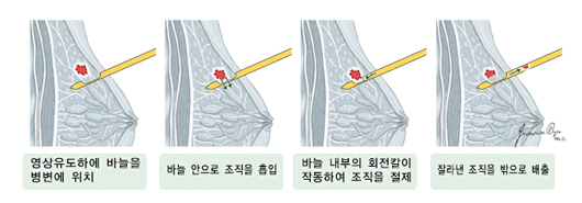 맘모톰 조직검사