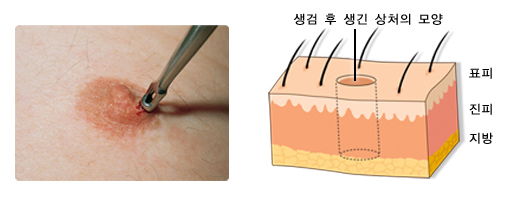 펀치 생검