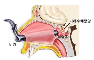 경접형동 접근법에 의한 뇌하수체 종양 제거술
