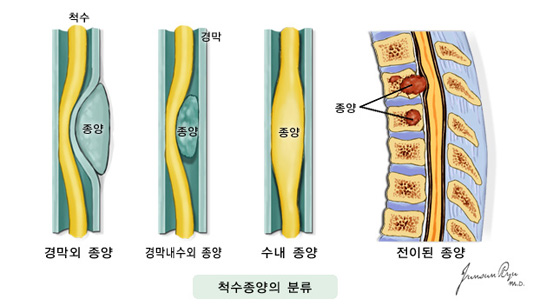 척수종양의 분류