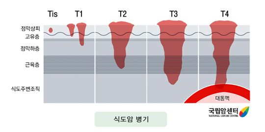 식도암의 병기(1)