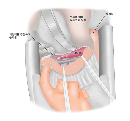 개흉술하에서 식도를 주위조직과 분리하는 모습