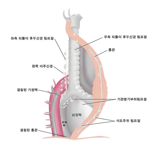 식도절제술시 같이 시행하는 림프절 제거술