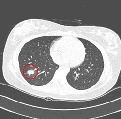 흉부 전산화단층촬영 사진 -> 슬부에 발생한 활막육종(synovial sarcoma)환자에서 시행한 흉부 CT소견상 우측 폐 하엽으로의 전이소견이 관찰됨