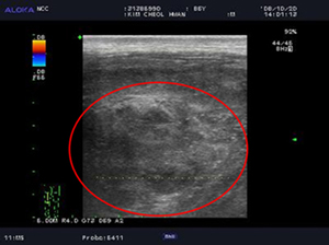 대퇴부에 발생한 다형성 지방육종(Pleomorphic liposarcoma)환자의 초음파 검사사진