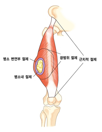 악성 연부조직 종양의 수술 방식