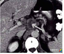 췌장암의 전산화 단층 촬영