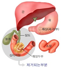 췌장암의 Whipple 수술