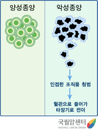 양성 종양과 악성 종양