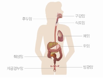 흡연으로 인해 발생할 수 있는 암