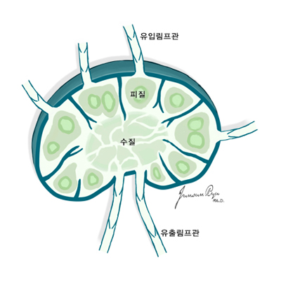 악성림프종의 발생부위