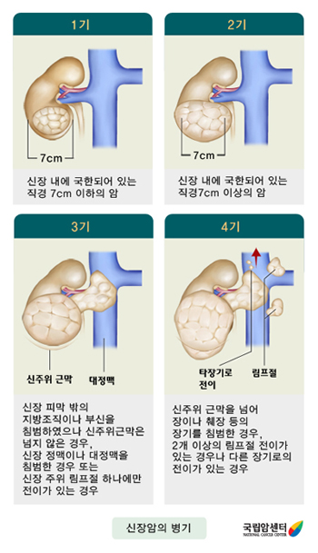 신세포암의 병기 분류