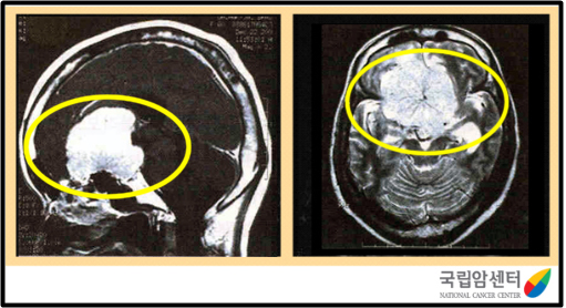 전두엽에 발생한 수막종의 뇌 자기공명영상 사진