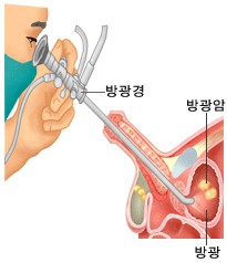 방광경 검사의 방법 방광암의 방광 내시경 시술 장면