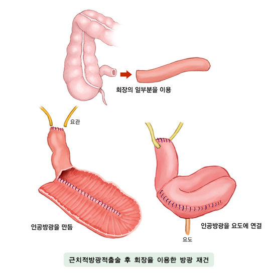 근치적방광적출술 후 회장을 이용한 방광재건