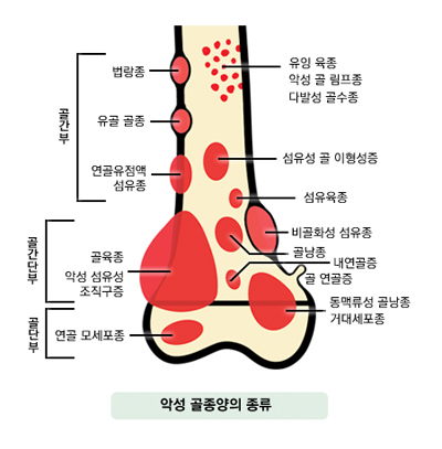 악성 골종양의 종류