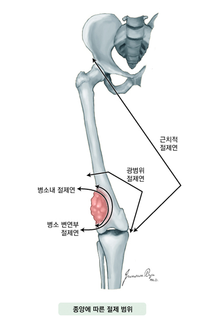 종양에 따른 절제 범위