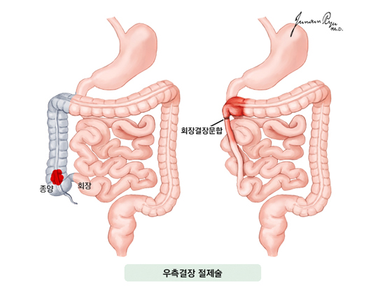 우측결장 절제술