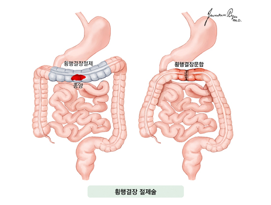 횡행결장 절제술