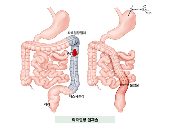 좌측결장 절제술