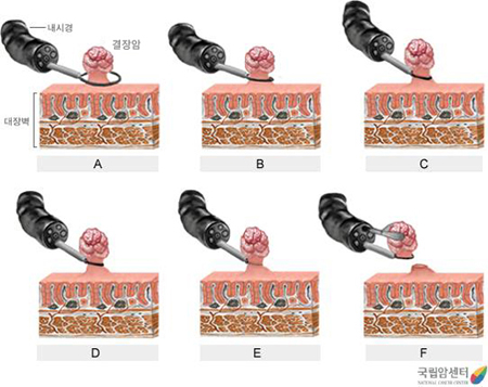 결장암의 내시경적 절제술