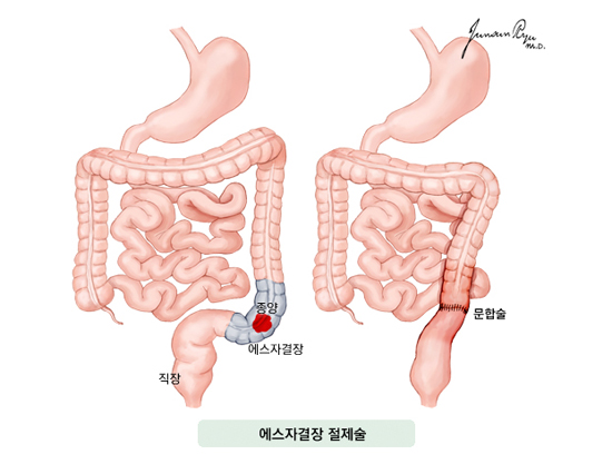 에스자결장 절제술