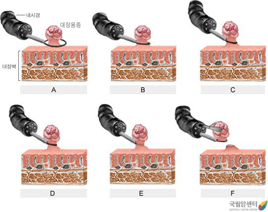 대장암의 내시경적 용종 절제술
