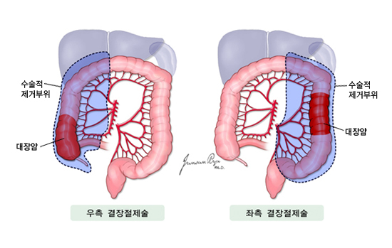 결장절제술