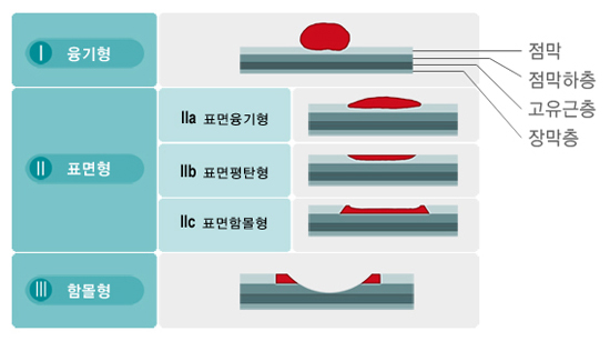 조기위암의 육안분류