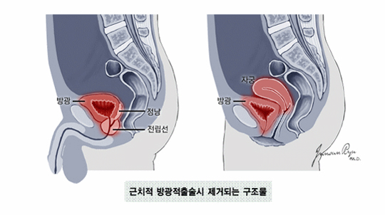 근치적 방광적출술시 제거되는 구조물