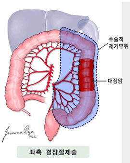 좌측 결장절제술