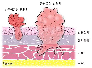진행 단계에 따른 방광암의 분류