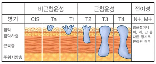 방광암의 진행단계(병기)