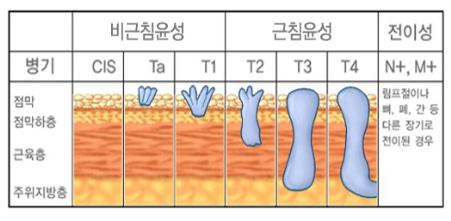 신우요관암의 진행단계