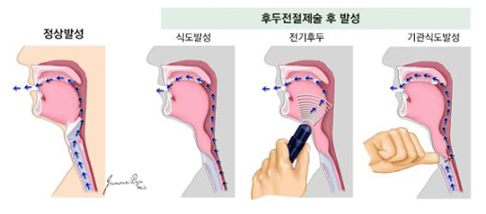 후두 전절제술 후의 여러가지 음성 재활법