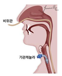 후두 부분절제술 후의 재활