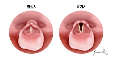 내시경을 통해 관찰한 후두의 모양