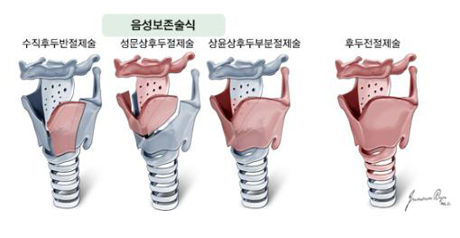 현재 널리 쓰이고 있는 후두암의 수술법들