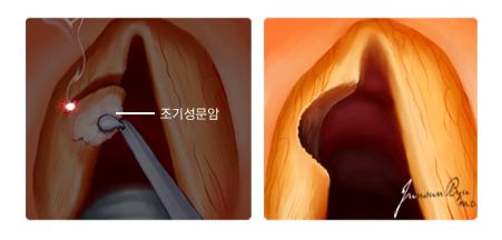 레이저 성대절제술