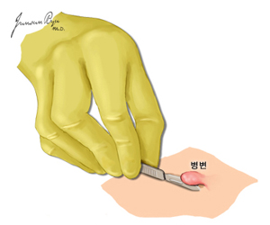 면도 생검