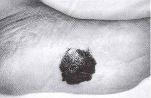 선단 흑색종(3) : 발바닥에 발생한 흑색의 종양