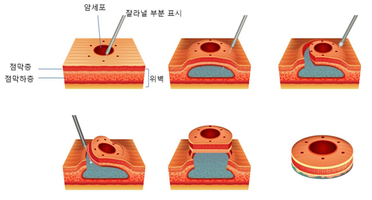 내시경적 점막하박리술