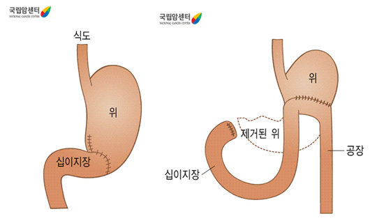 위아전절제술 후의 소화기계 구조